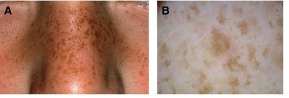 Веснушки [16]