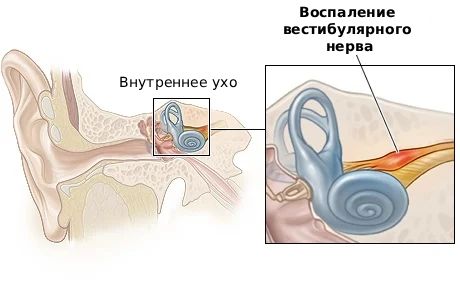 Вестибулярный нейронит