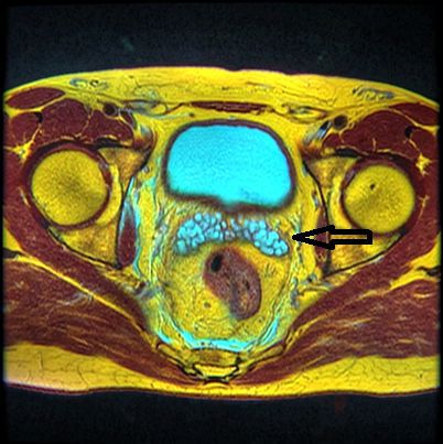 Магнитно-резонансная томография органов малого таза. Стрелкой указаны семенные пузырьки.