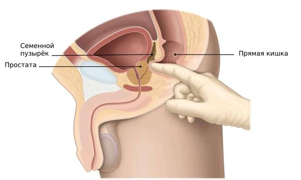 Киста простаты у мужчин