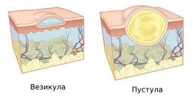 Везикула и пустула Везикула и пустула