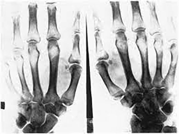 Рентгенография кистей рук при вибрационной болезни