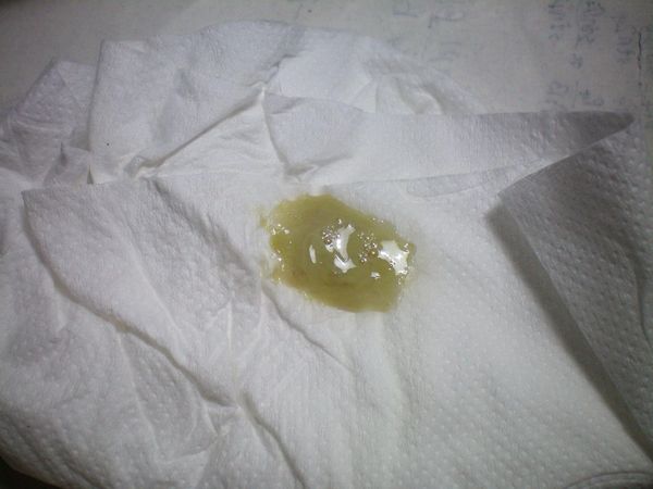 Гнойная мокрота [26]