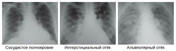 Стадии развития пневмонии на рентгенограмме