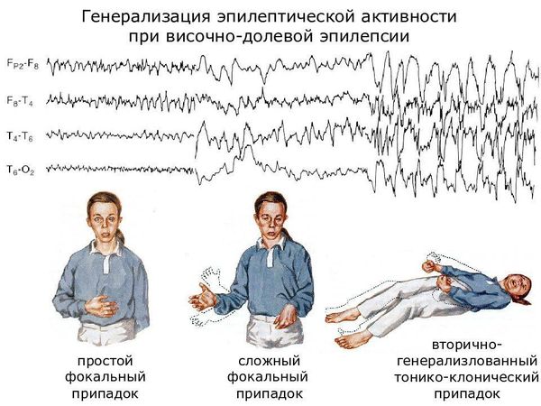 Чем опасна височная эпилепсия