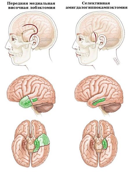 Передняя медиальная височная лобэктомия и селективная амигдалогиппокампэктомия [23]
