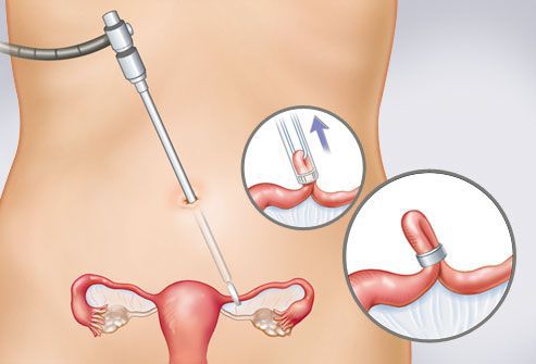 Лапароскопическое лечение трубной внематочной беременности