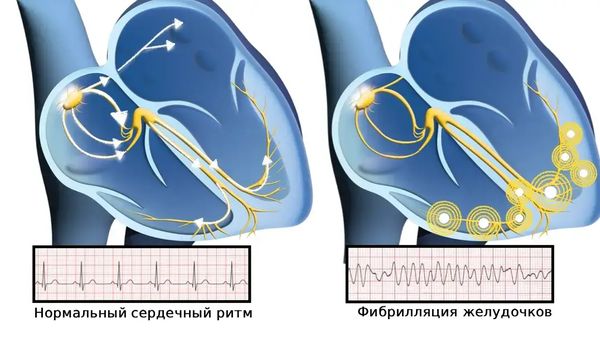 Фибрилляция желудочков — одна из причин внезапной сердечной смерти