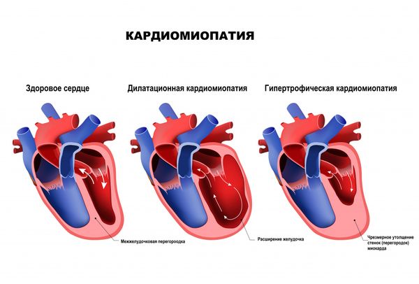 Виды кардиомиопатий