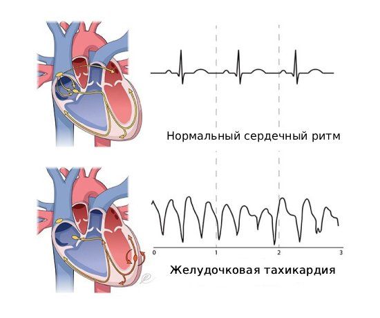 Желудочковая тахикардия