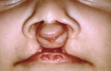 Синдром Ван дер Вуда [17]