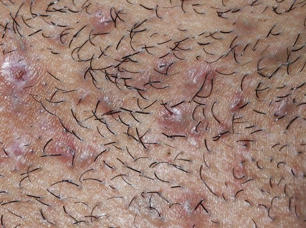 Черные точки в зоне роста вросших волос [13]