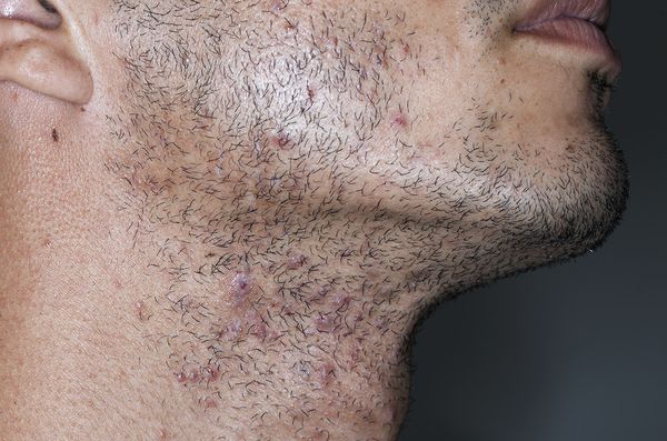 Проявление псевдофолликулита [13]