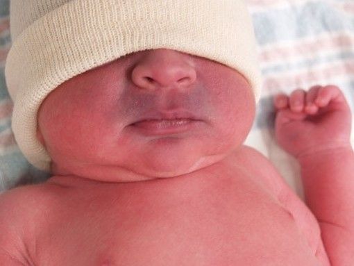 Акроцианоз носогубного треугольника [20]