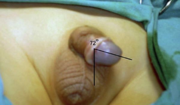 Перекручивание полового члена [1]