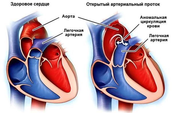 Врождённый порок сердца