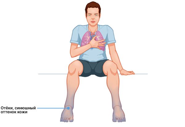 Периферические отёки и синюшность