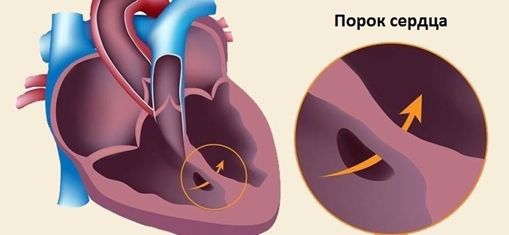 Секс и сердечная недостаточность