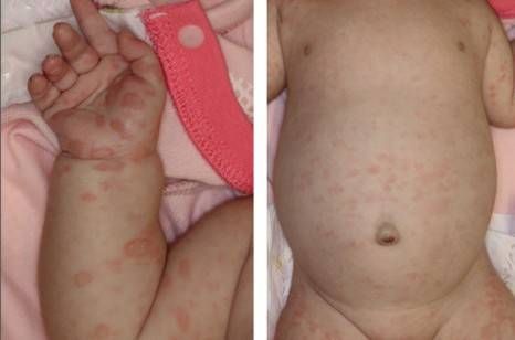 Ребёнок с признаками врождённого сифилиса [12]