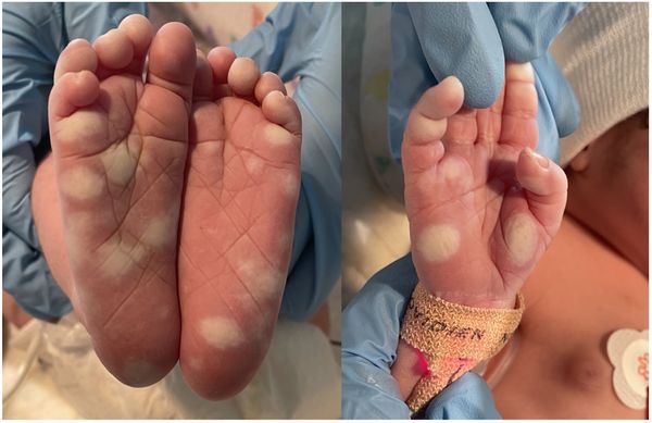 Сифилитическая пузырчатка [13]