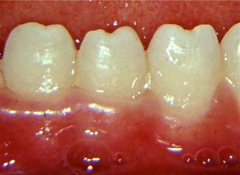 Зубы Гетчинсона [11]