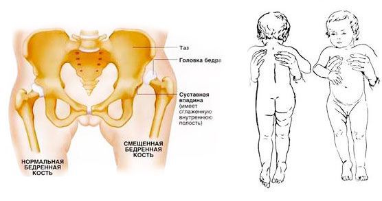 Дисплазия тазобедренных суставов: как лечит остеопатия врожденную патологию