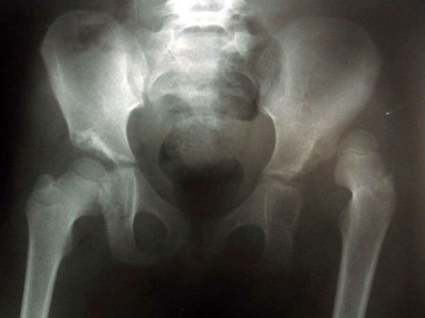 Врожденный вывих тазобедренного сустава на рентгене