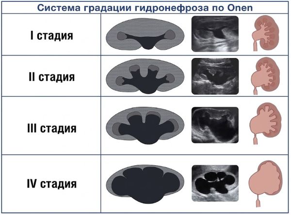 Классификация стадий гидронефроза по Onen [13]