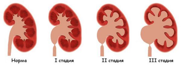 Стадии развития гидронефроза Стадии развития гидронефроза