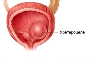 Уретероцеле Уретероцеле