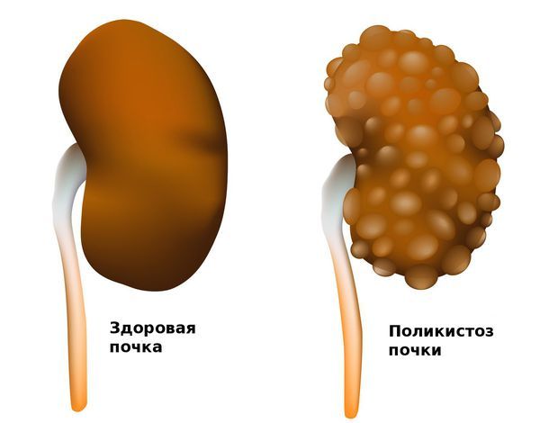 Здоровая почка и почка с поликистозом Здоровая почка и почка с поликистозом