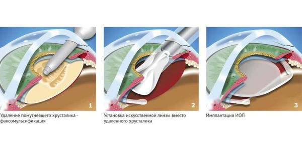 Помутнел искусственный хрусталик что делать