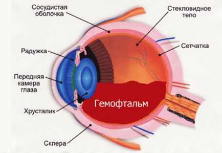 Гемофтальм