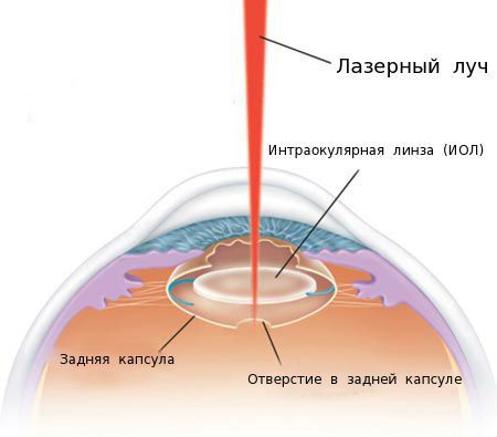 YAG-лазерная дисцизия капсулы хрусталика