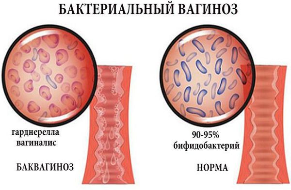 bakterialnyy vaginoz s