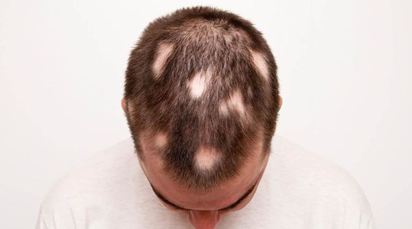 gnyozdnaya alopeciya s