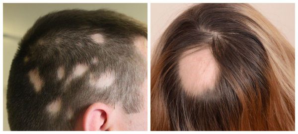 gnyozdnaya ochagovaya alopeciya s