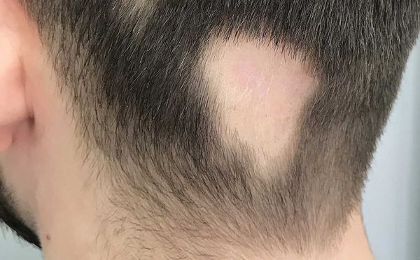 lokalnaya forma gnyozdnoy alopecii s
