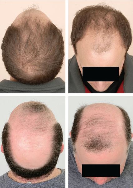 Выпадение волос у мужчин [25]