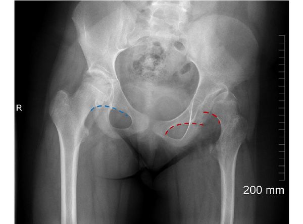 Линия Шентона: синяя линяя — сохранная, красная — «разорванная» [22]