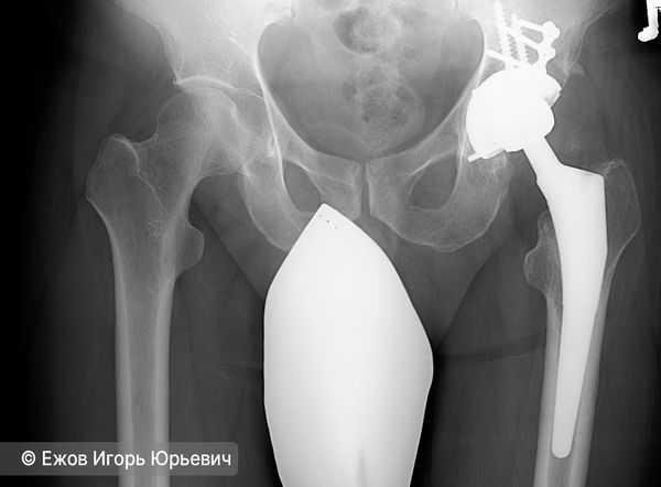 Тотальное эндопротезирование
