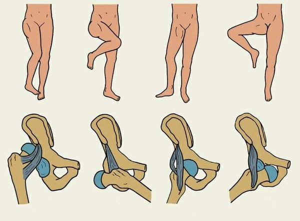 Виды вывихов бедра