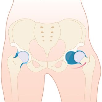 Вывих бедра