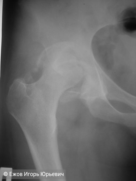 Застарелый вывих