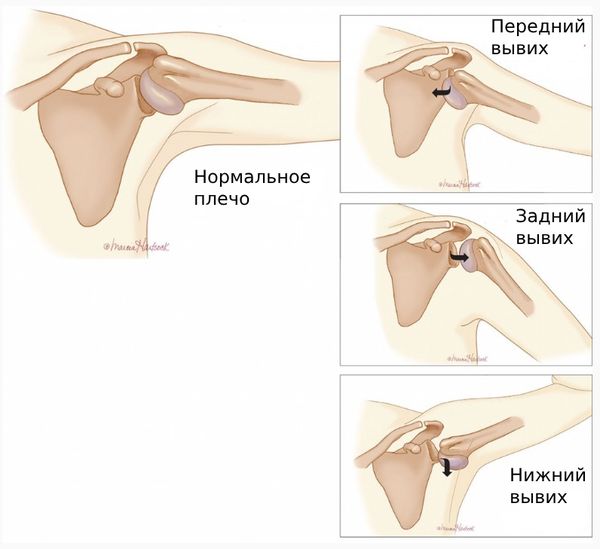 Привычный вывих плеча: лечение и реабилитация в Одессе | Медицинский дом Odrex