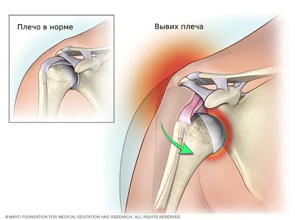 Вывих плечевого сустава