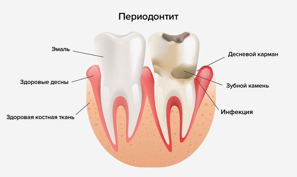 periodontit s