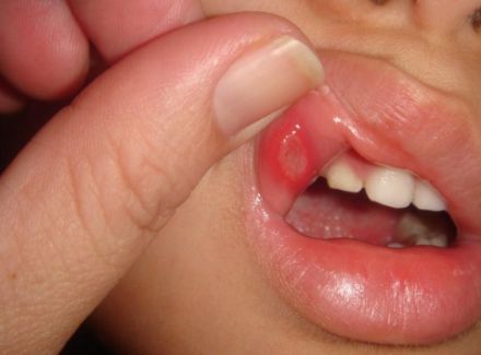 Афта во рту при ящуре [12]