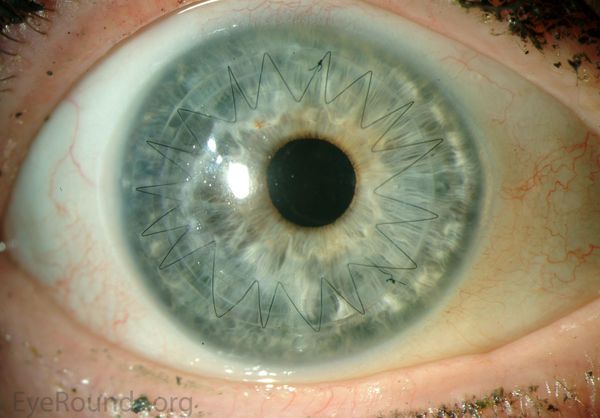 Глаз после проникающей кератопластики