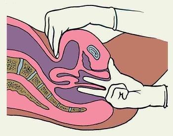 Ректовагинальное двуручное исследование